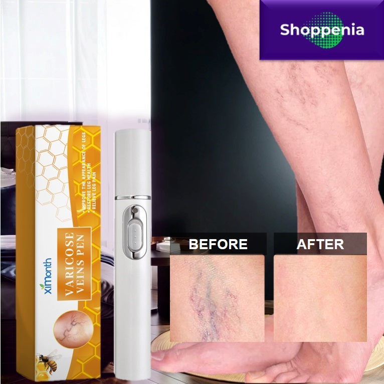 varicose vein relief device before after